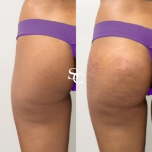 Hip Dip Filler Before And After