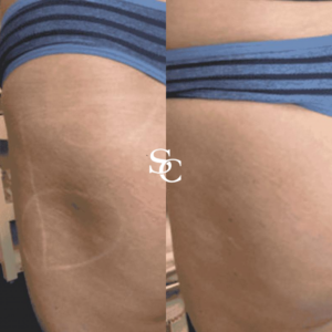 Hip Dip Filler Before And After Photo