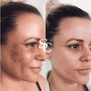 IPL Before and After By Skin Club