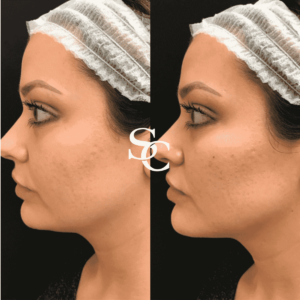 Jawline Contouring Before After