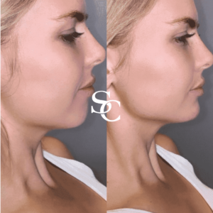 Jawline Contouring Treatment in Melbourne