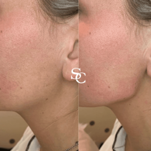 Jawline Contouring by Skin Club