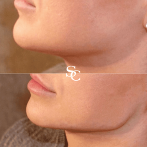 Jawline Slimming Before After
