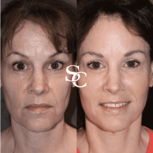 Jowls Treatment Before and After
