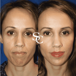 Jowls Treatment in Melbourne