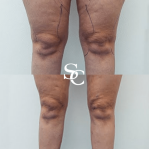 Knee Liposuction