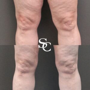 Knee-Liposuction-Before-and-After