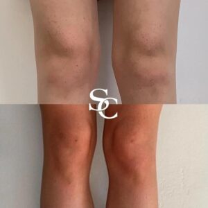 Knee Liposuction By Skin Club
