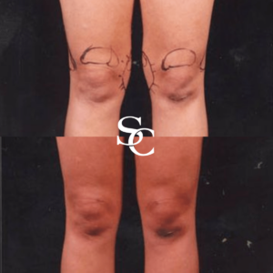 Knee Liposuction Expert in Melbourne