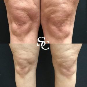 Knee Liposuction Melbourne