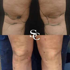 Knee Liposuction Result