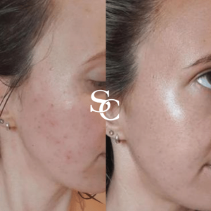 LED Light Therapy Before and After