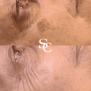 Laser Pigmentation Removal Before-and-After