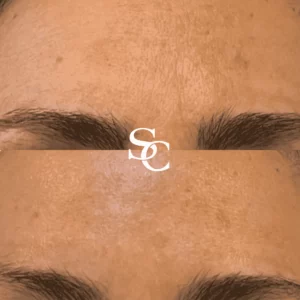 Laser Skin Treatment Before and After Melbourne