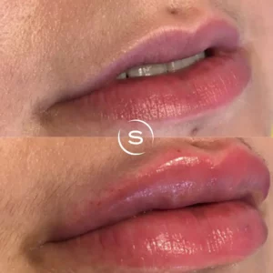 Lip Filler Before and After