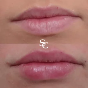Lip-Fillers-Treatment