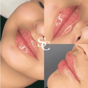 Lip Lift By Skin Club