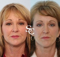 Liquid Facelift Before After