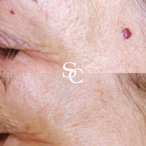 Lumps and-Bumps Treatment Before And After
