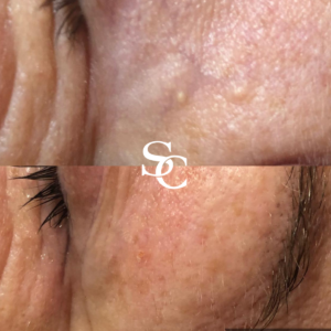 Milia Removal Before and After