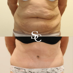 Mummy Tummy Liposuction Before And After