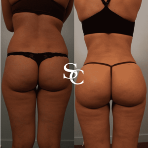 Non Surgical Butt Fillers Before And After