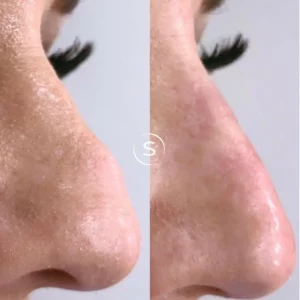 Nose Filler Before and after