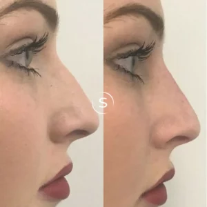 Nose Filler By Skin Club