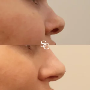 Nose Filler Treatment By Skin Club