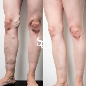 Broken Capillaries and Prominent Veins Before and after