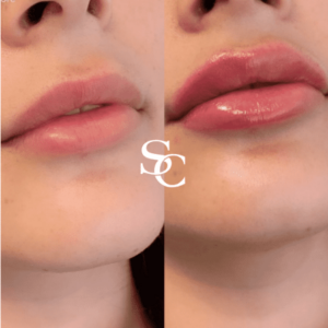 Russian Lips Before After