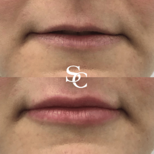 Russian Lips Before After Melbourne