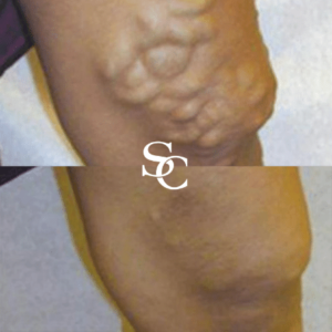 Sclerotherapy Before And After