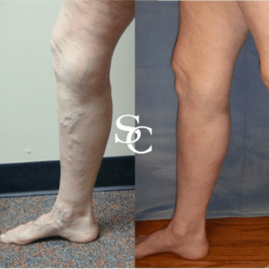 Sclerotherapy Before And After By Skin Club