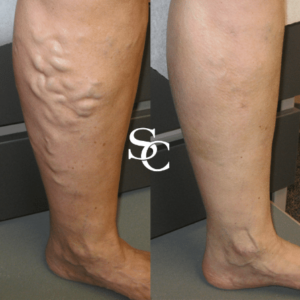 Sclerotherapy Doctor Melbourne
