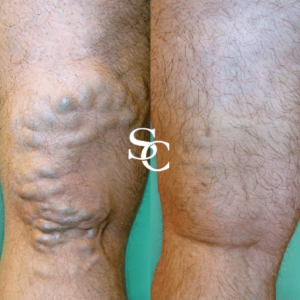 Sclerotherapy Expert Melbourne