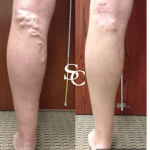 Sclerotherapy Result