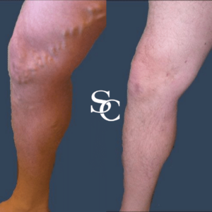 Sclerotherapy procedure