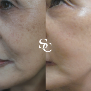 Skin Booster Injections Before and After