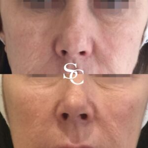 Skin Hydration Injection Before and After