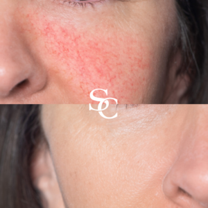 Skin Redness Treatment Before And After