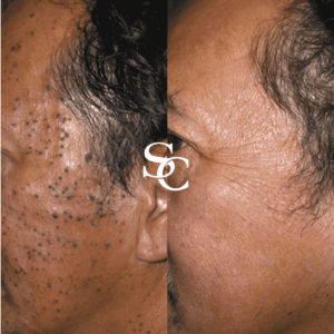 Skin Tag Removal Before and After