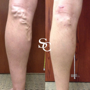 Spider Vein Before and After