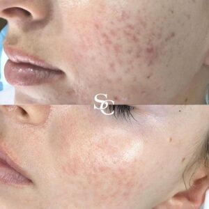 Spot Treatment Before and After
