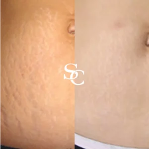 Stretch Marks Removal Clinic Melbourne