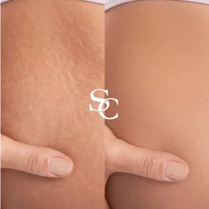 Stretch Marks Removal Melbourne Before and After