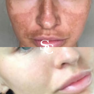 Sun Damage-Skin Before And After