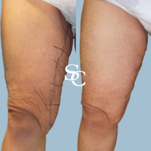 Thigh Liposuction Treatment