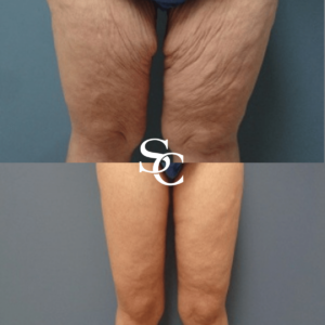 Thigh Liposuction in Melbourne