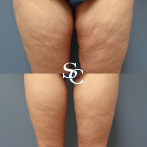 Thigh Liposuction Result